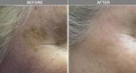 Chicago Laser Skin Rejuvenation